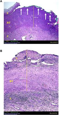 Pilot Study on the Effect of a Single Topical Application of Trichloroacetic Acid 85% on Normal Cervical Tissue